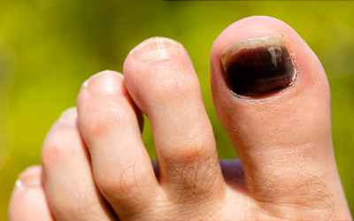 Why Are My Toenails That Color?